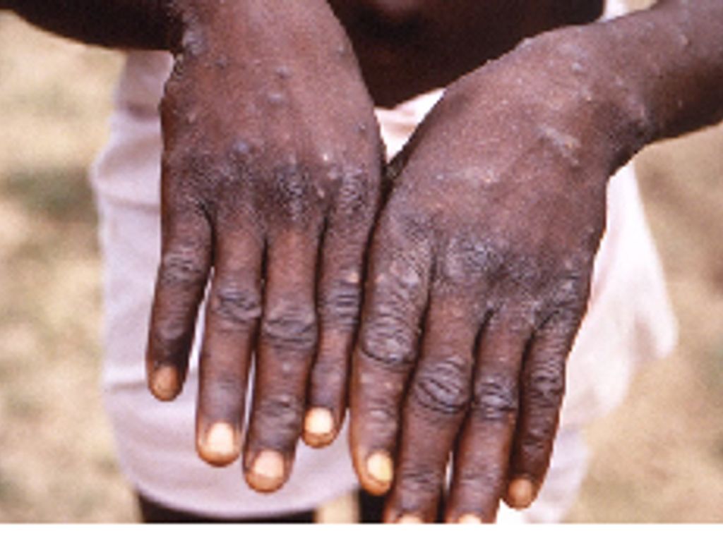 Ghana’s Mpox cases hit 346 after 18 new infections