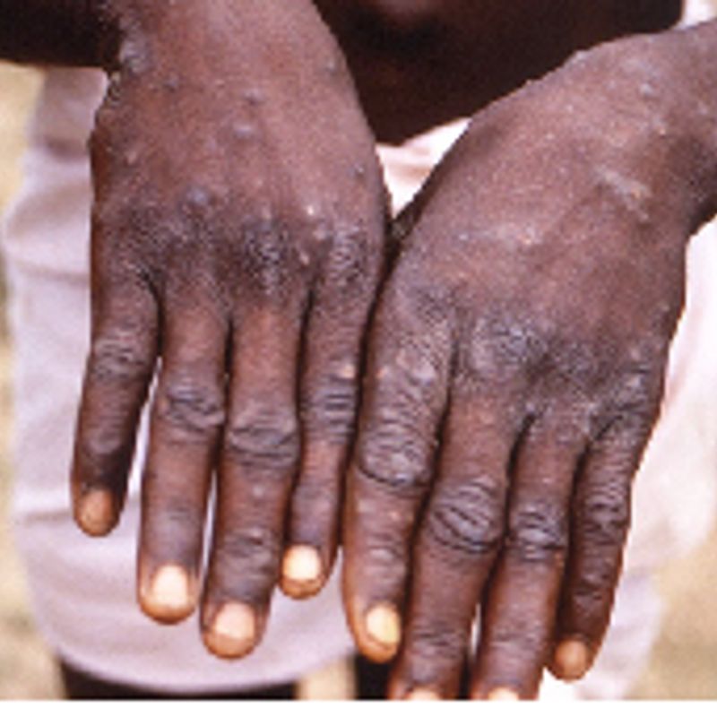 Ghana’s Mpox cases hit 346 after 18 new infections