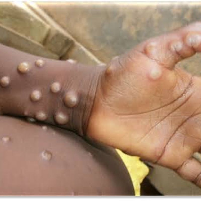Ghana confirms 22 new mpox cases, total reaches 735