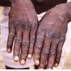 Ghana’s Mpox cases hit 346 after 18 new infections